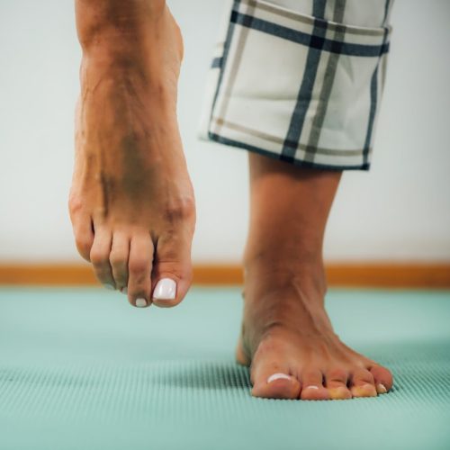 Bunion