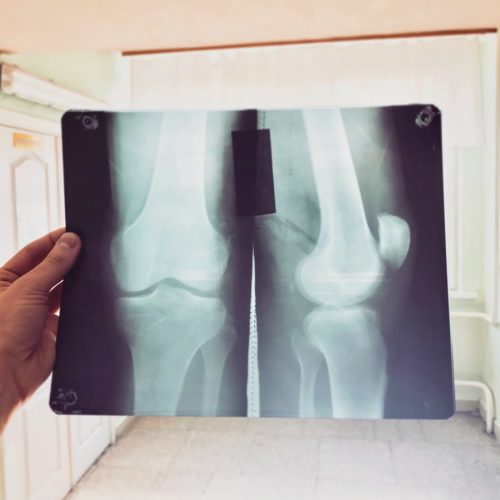 Fracture