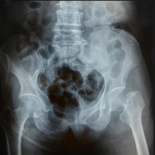 Pelvic